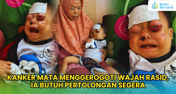 Kanker Mata Menggerogoti Wajah Rasid, Ia Butuh Pertolongan Segera